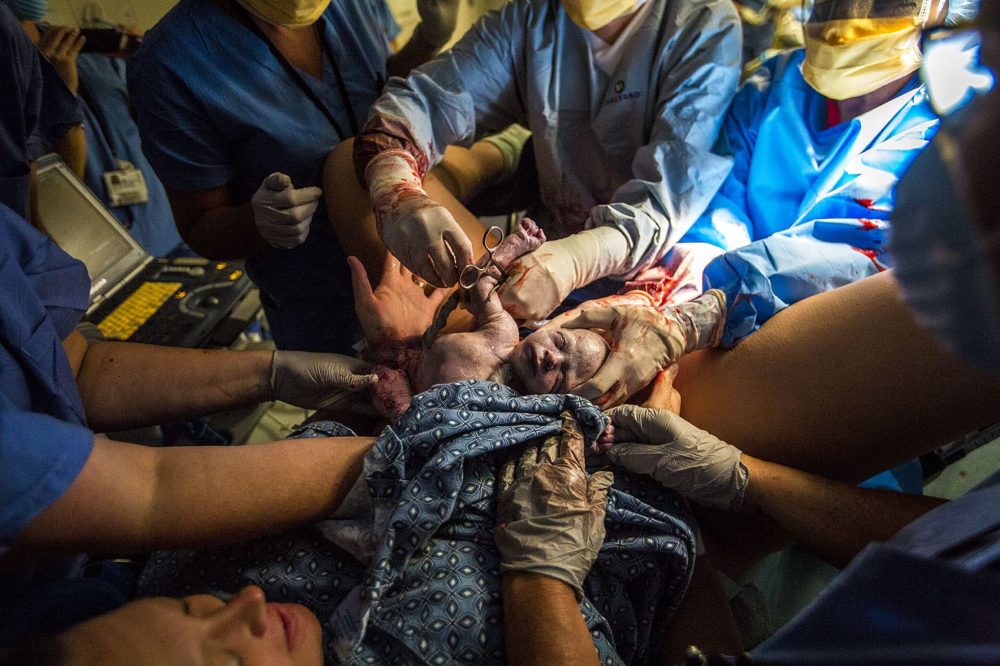 The obstetrics team at South Shore Hospital work as baby Bryce is born and placed on Melisa to see. Photo by Jesse Costa for WBUR